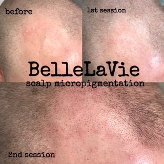 Scalp Micropigmentation