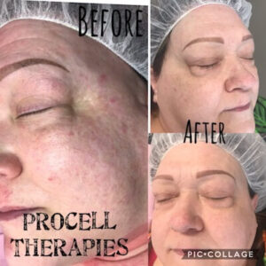 Belle La Vie Procell Treatment