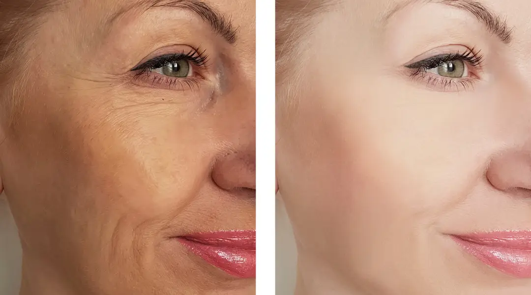 Botox Before & After